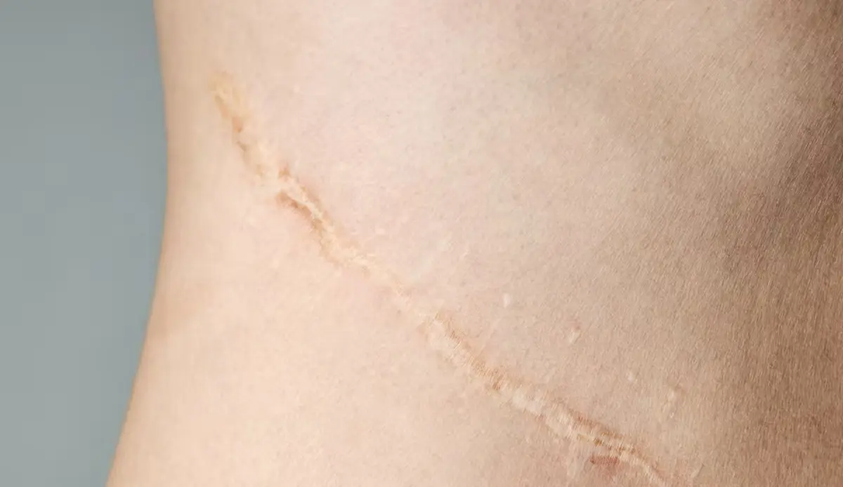 Close up photo of a scar on the skin