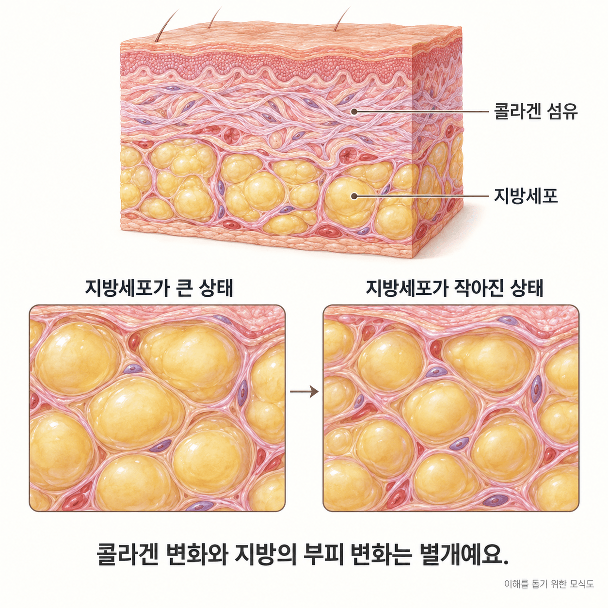 콜라겐 섬유와 지방세포를 구분하고 지방세포 크기 변화를 비교하는 모식도