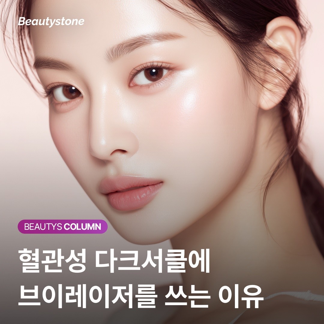 왜 뷰티스톤은 다크서클에 브이레이저를 쓸까요? "혈관만 쏙 골라내는 파장의 힘"