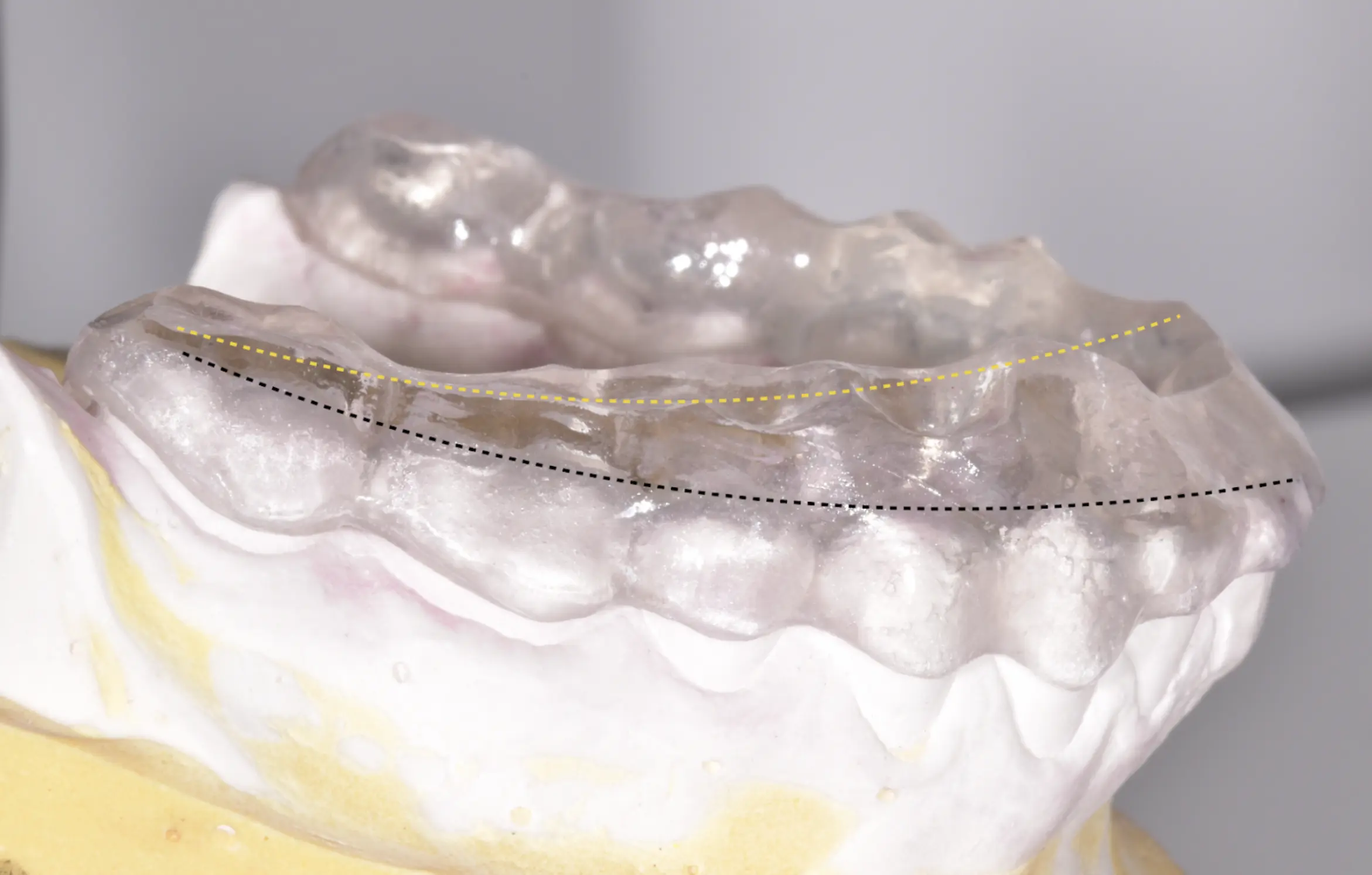 Splint (temporary mouthguard to test the future therapeutic position) The yellow line highlights the desired change of occlusal plane