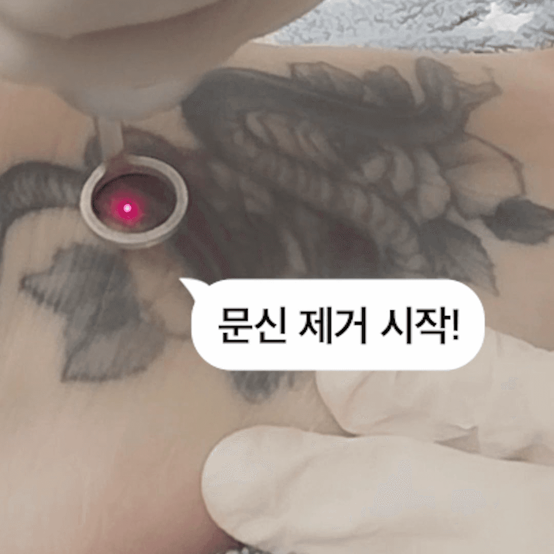 배보다 배꼽이 더 큰 문신 제거, 지우는 데 새기는 비용의 10배가 드는 이유