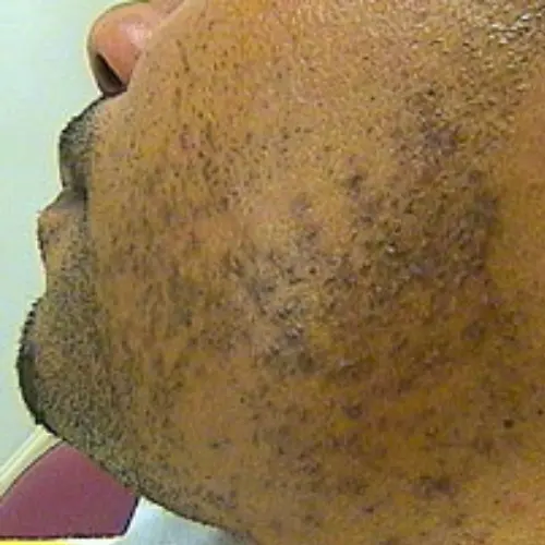 Before laser hair removal at The Vancouver Aesthetician — ingrown hairs and pigmentation in the beard area on melanin-rich skin