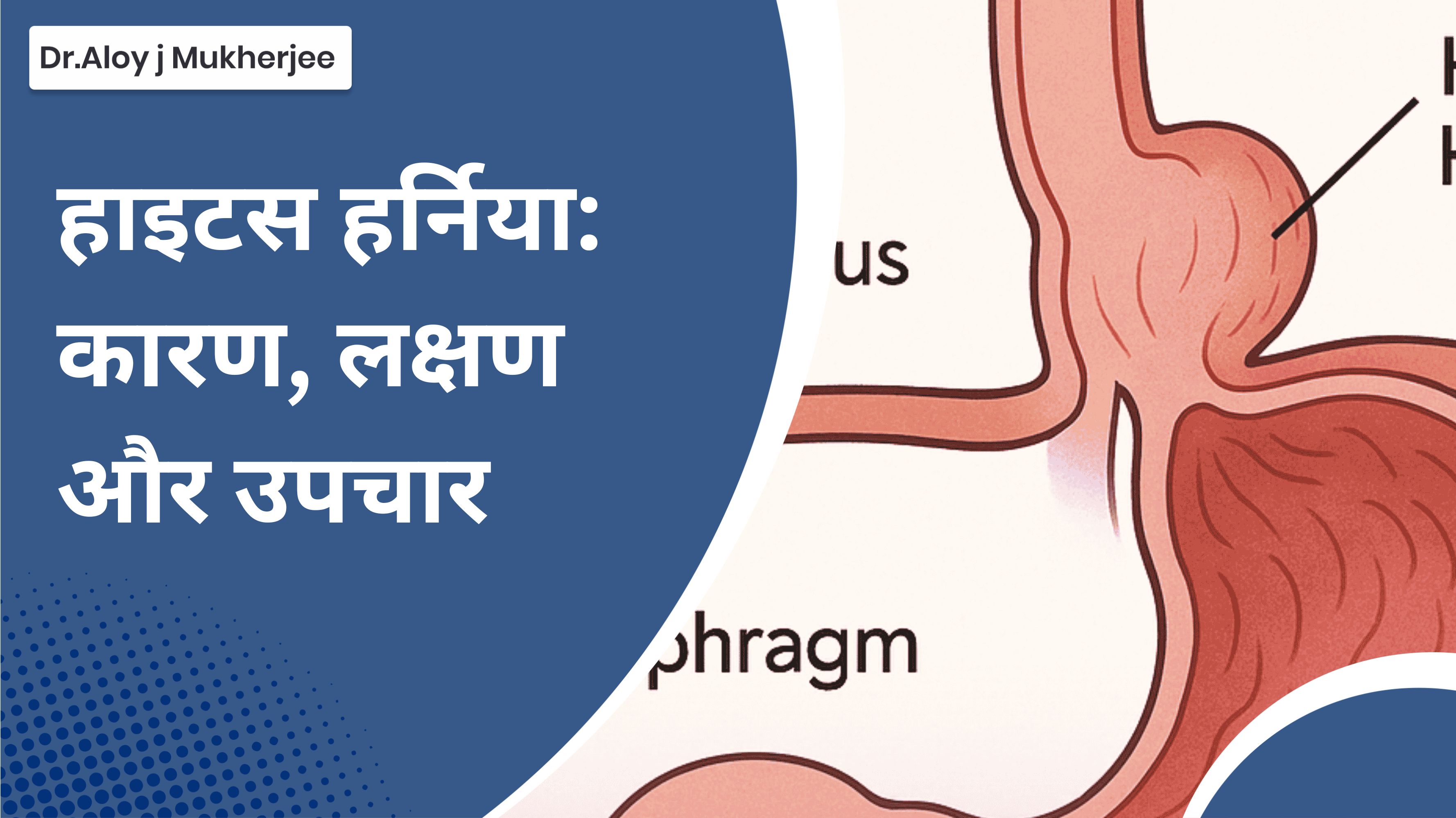 hiatus hernia meaning in hindi