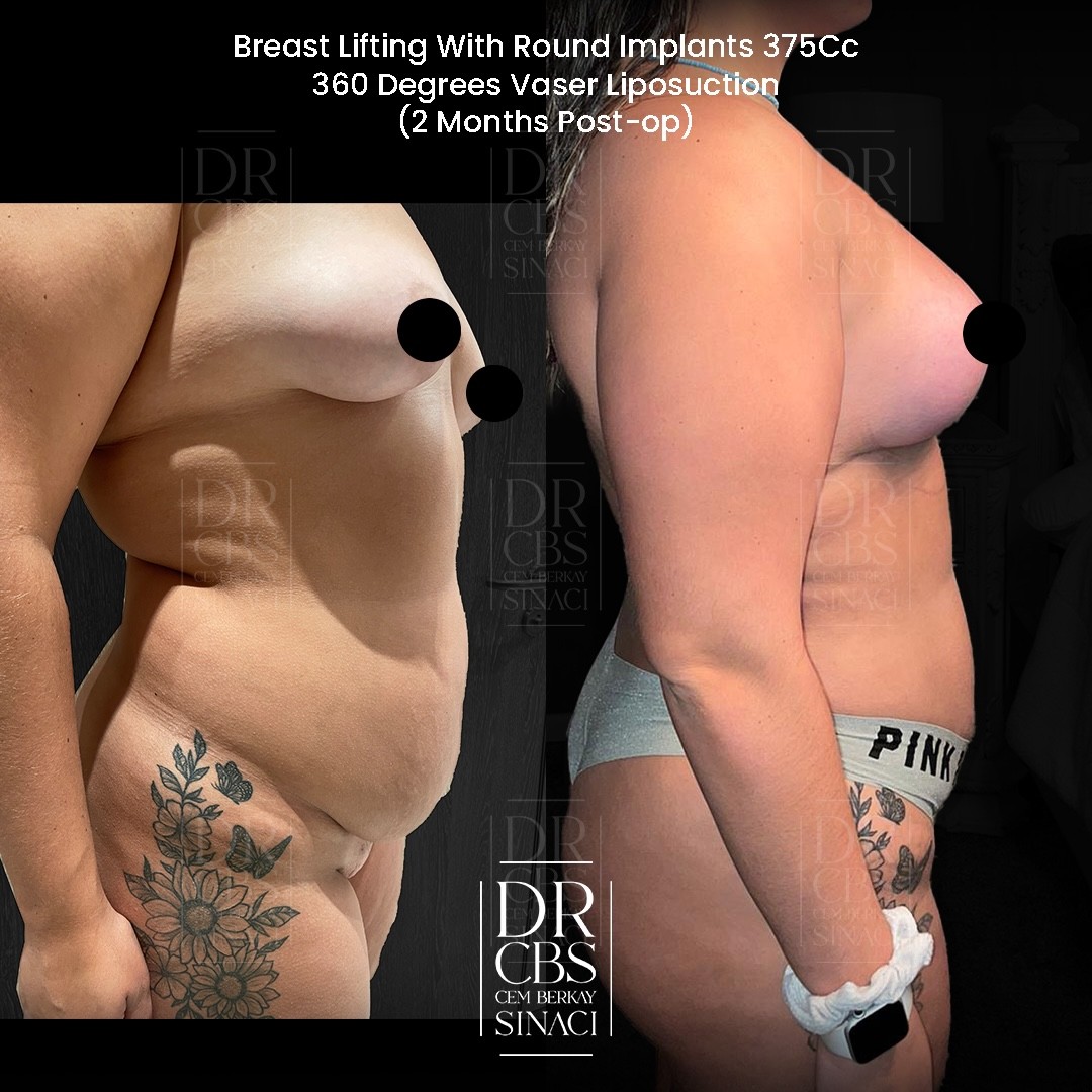 tuberous breast deformity before after of breast lift with implant side view