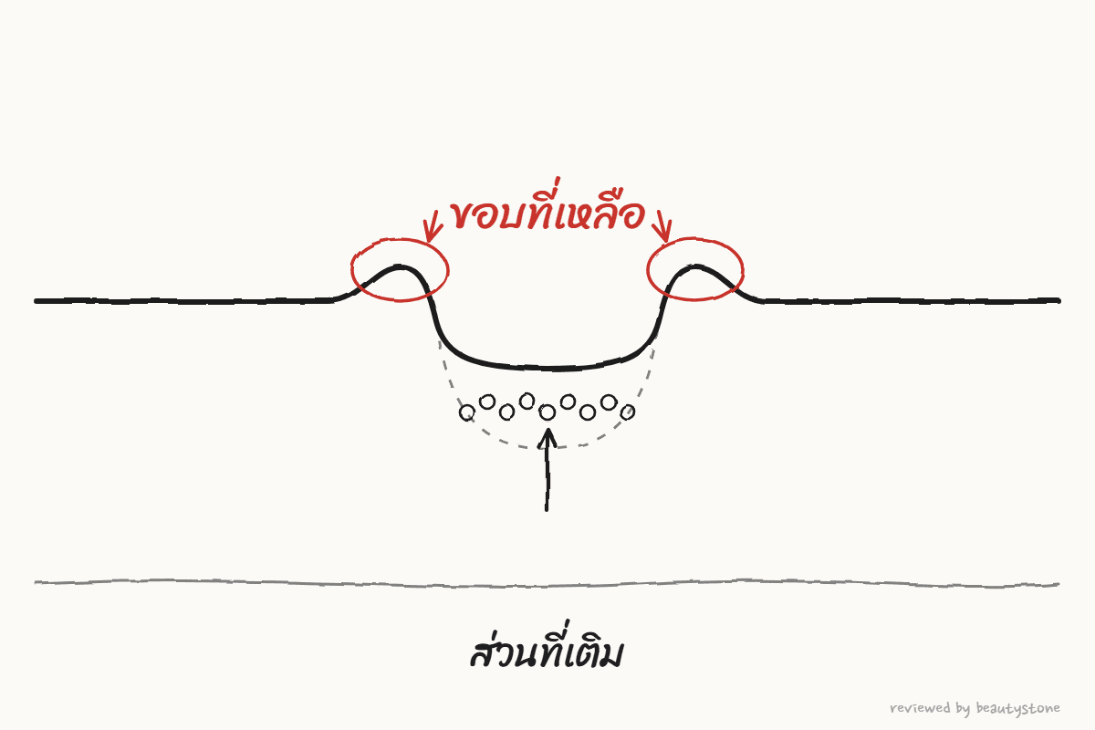 ภาพวาดปากกาแสดงหน้าตัดที่เติมก้นหลุมแล้ว แต่ยังมีขอบนูนเหลืออยู่
