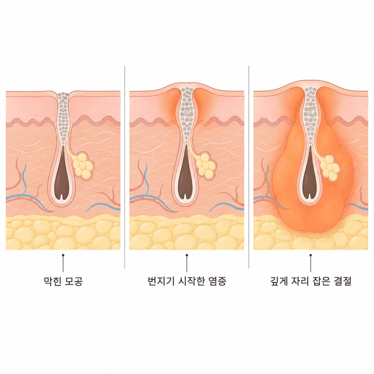 같은 여드름이라도 어디까지 왔는지에 따라 출발점이 달라요.