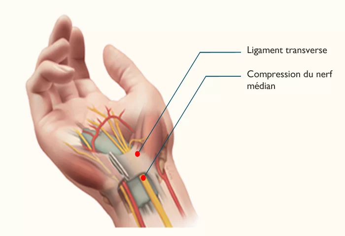 diagram of carpal tunnel syndrome