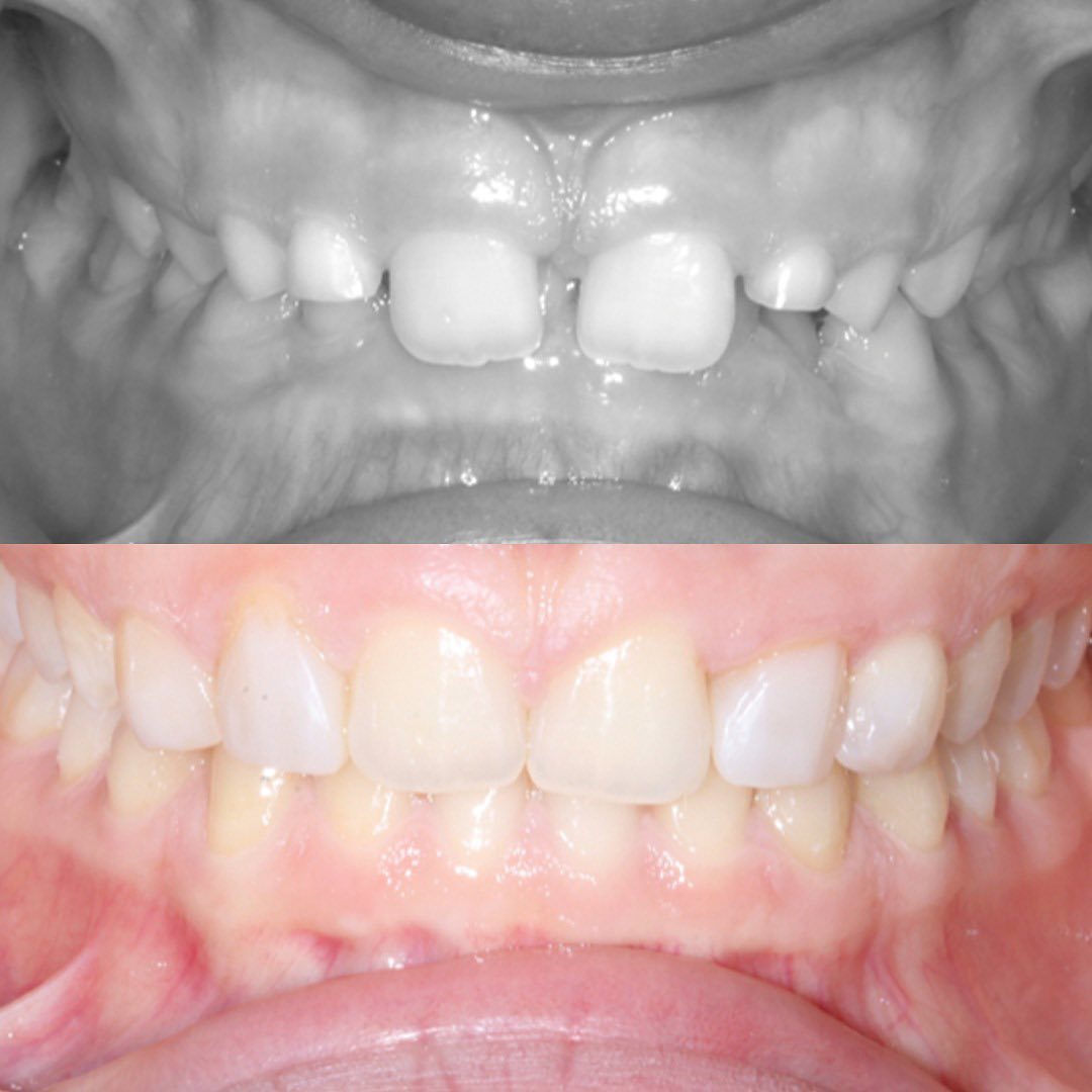 Invisalign® before and after photo at Invisalign Center Dubai showing gap correction and reduced gummy smile for a balanced look.
