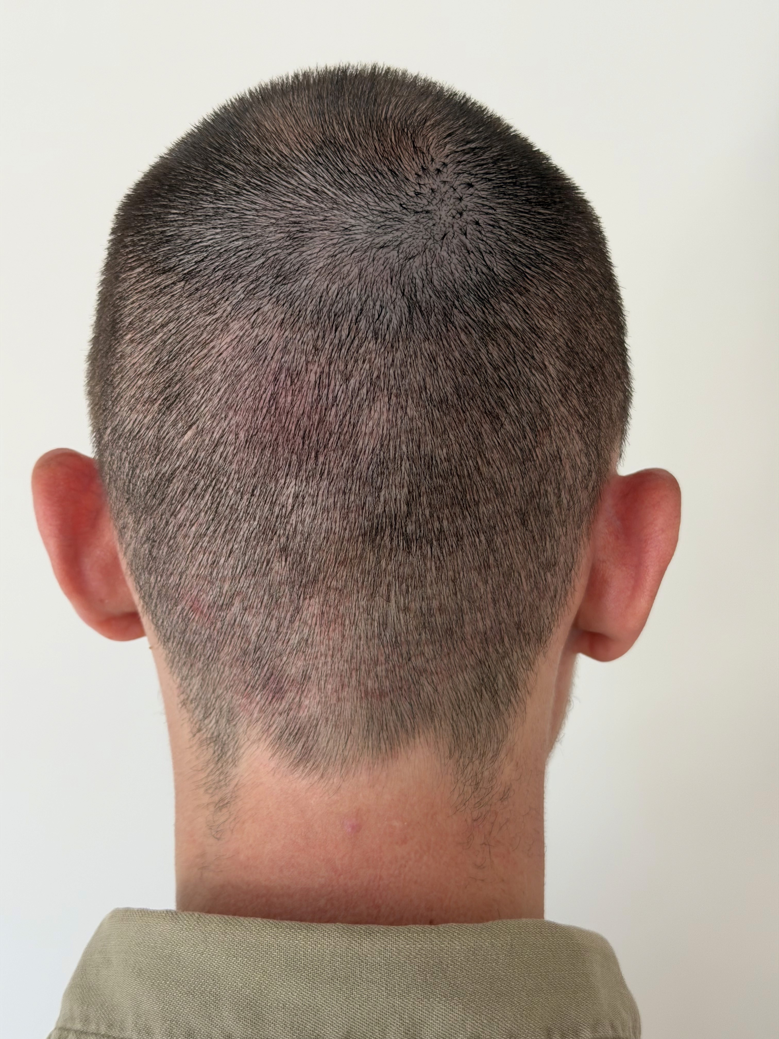 Shaved scalp area with short hair and mild redness following a hair transplant procedure