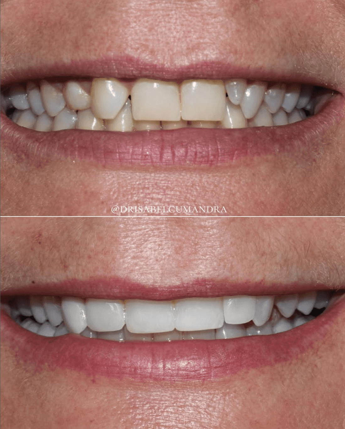 Dental Bonding Before and After at ScarboroSmiles Dental Clinic in Scarborough, ON | Best dentist in Scarborough.