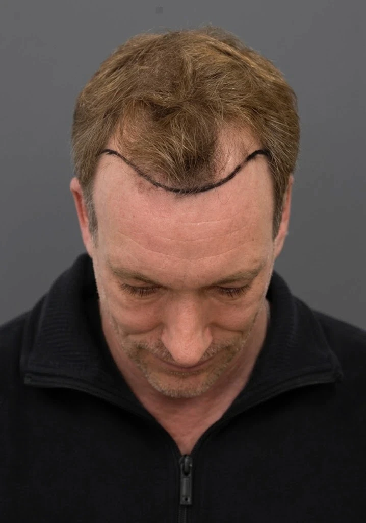 Vorher-Ansicht eines Patienten mit ausgeprägten Geheimratsecken und eingezeichneter Haarlinie vor der Haartransplantation in Istanbul