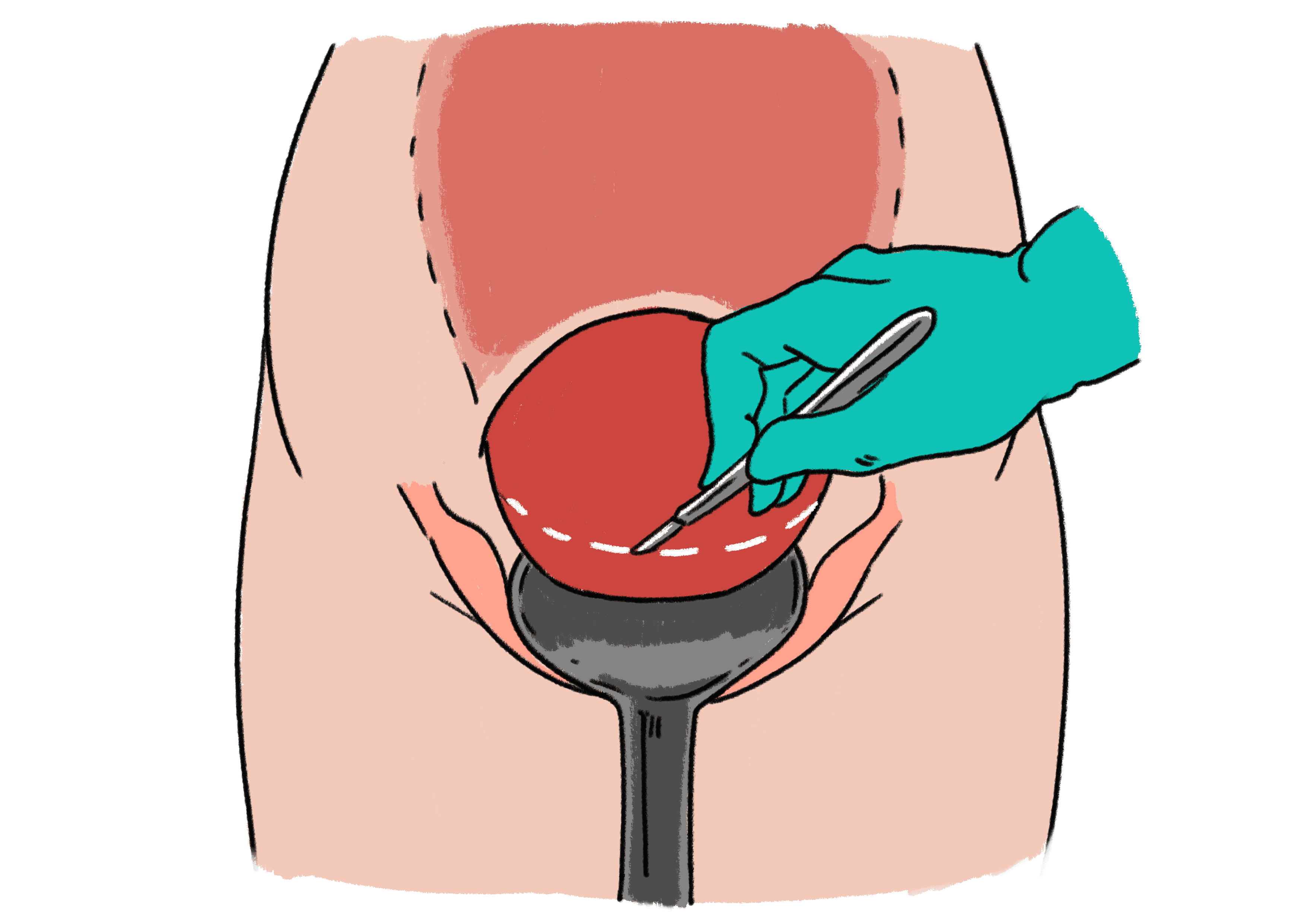 An illustration showing where a doctor will cut into the abdomen and womb to perform a caesarean. It is across the bikini line which is at the lower point of the womb.
