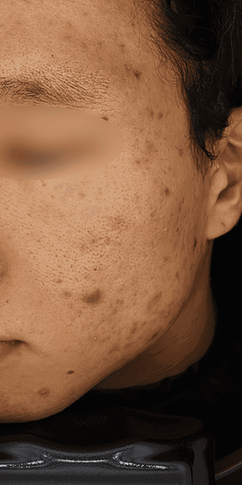Acne - Before