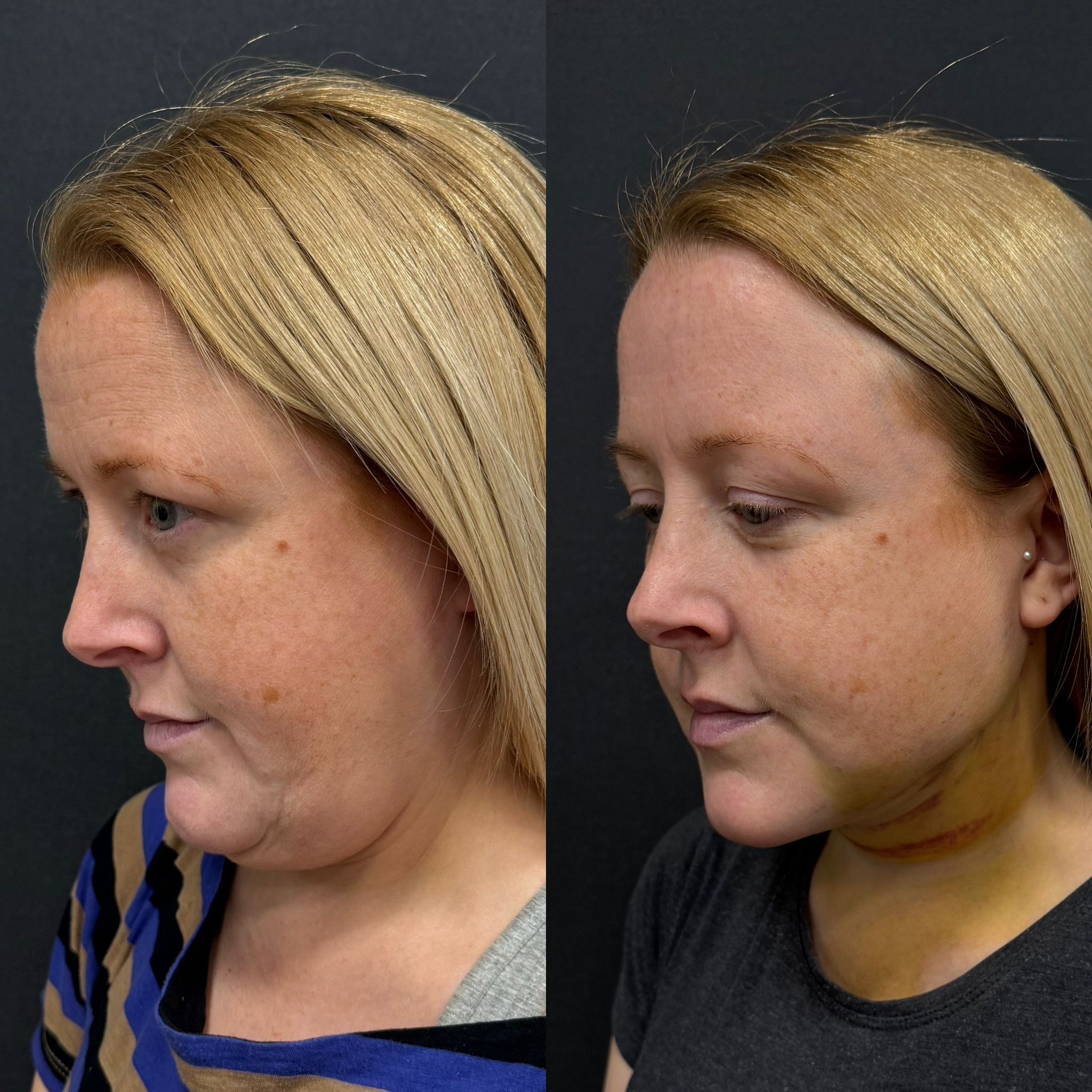 double chin laser liposuction with thread lift 1 day before after oblique view