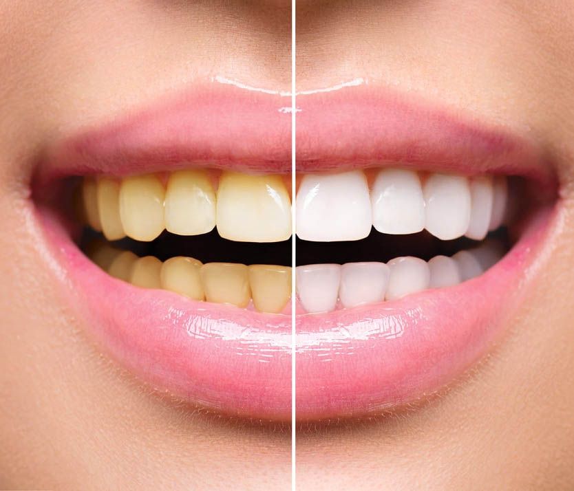 Sorriso com implante dentário ilustrado na gengiva, mostrando dentes brancos e saudáveis após reabilitação oral