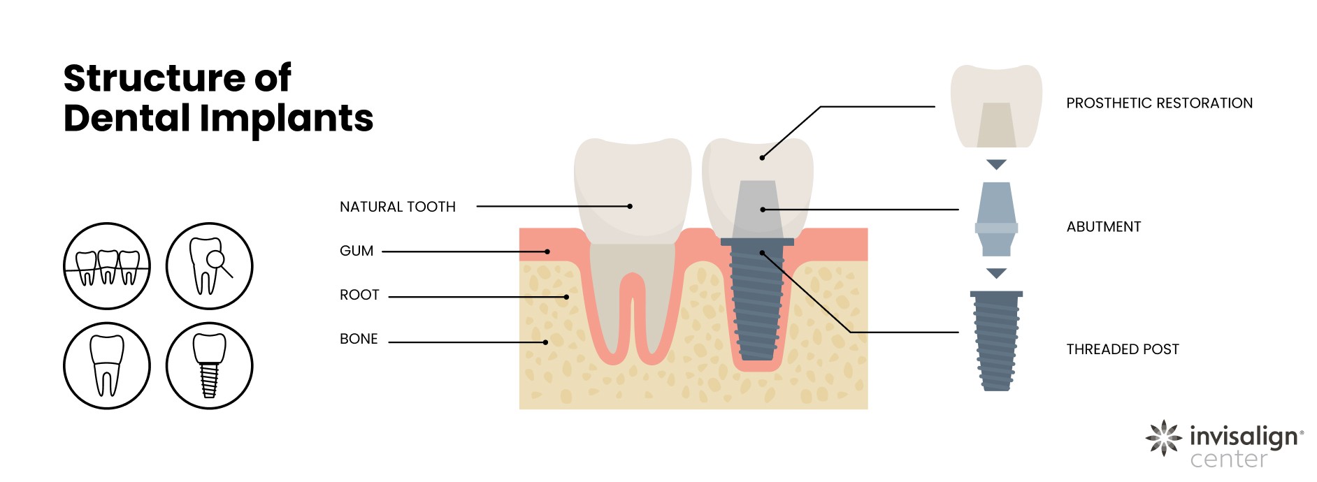 how dental implants are structured in 3 parts - post, abutment, and prosthetic restoration