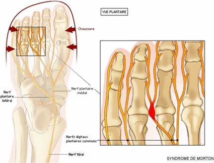 Schema d'un pied