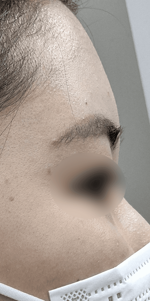 Forehead Filler - After