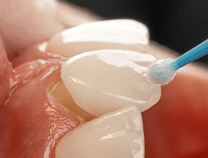 Hauchdünne Keramik-Veneers für ein natürliches Lächeln