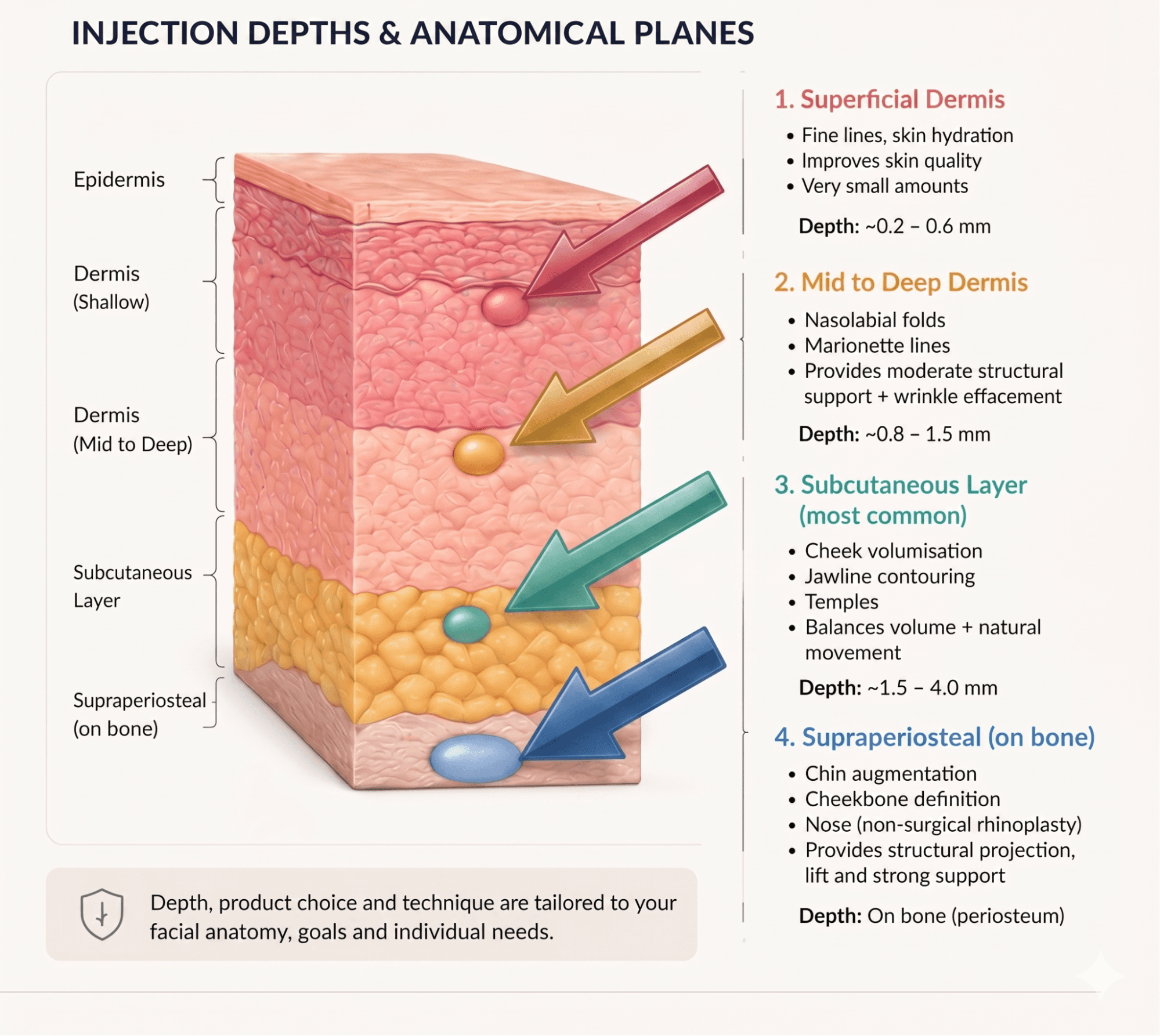Dermal filler injection depths showing facial filler placement across skin layers for different treatment areas