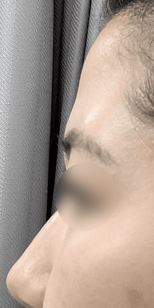 Forehead Filler - Before