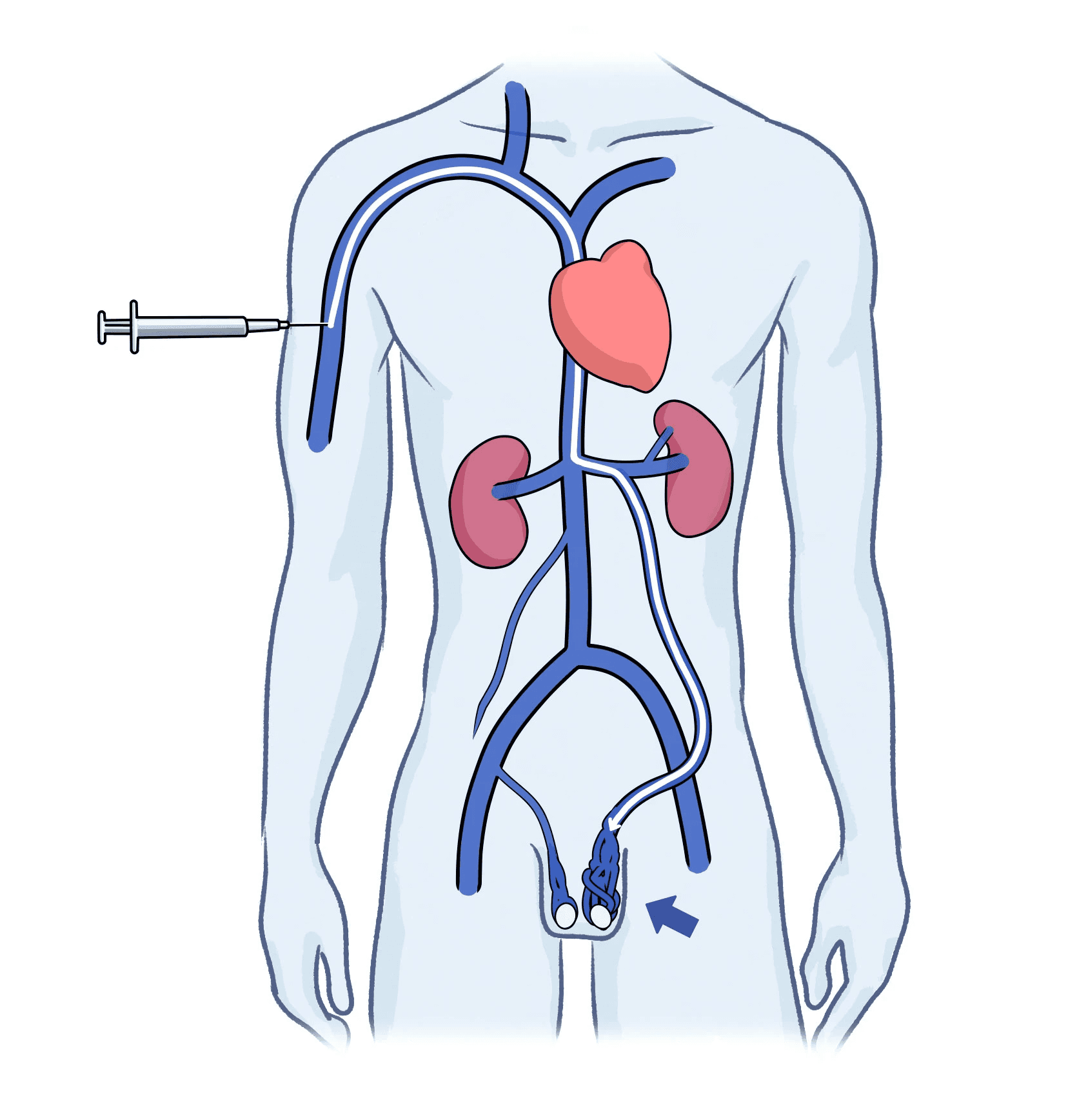 정계정맥류 색전술 일러스트