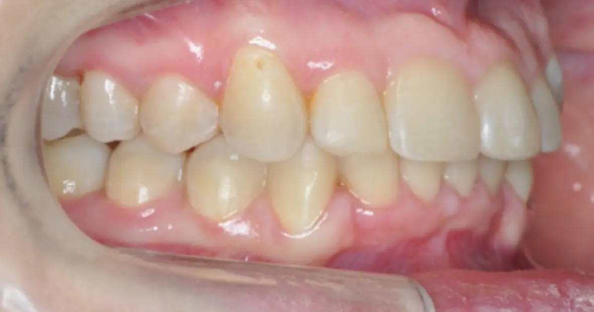 Prima e dopo il trattamento ortodontico funzionale, senza estrazione dei denti premolari
