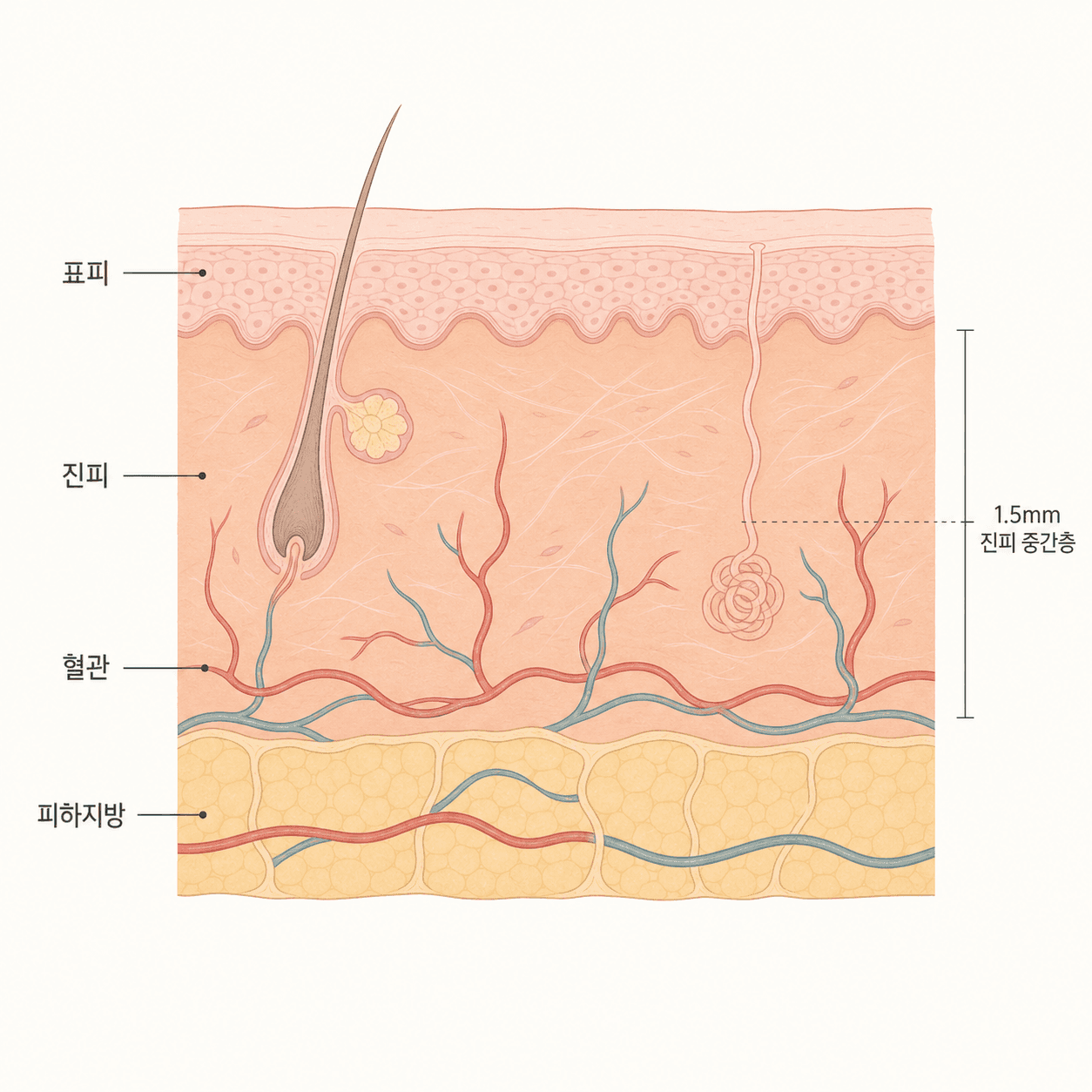 시술 후 진피 속 혈관이 확장된 피부 단면