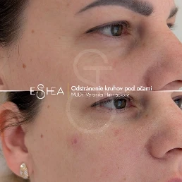 Fotografia pred a po korekcii tmavých kruhov pod očami kyselinou hyalurónovou – odstránenie unaveného výrazu