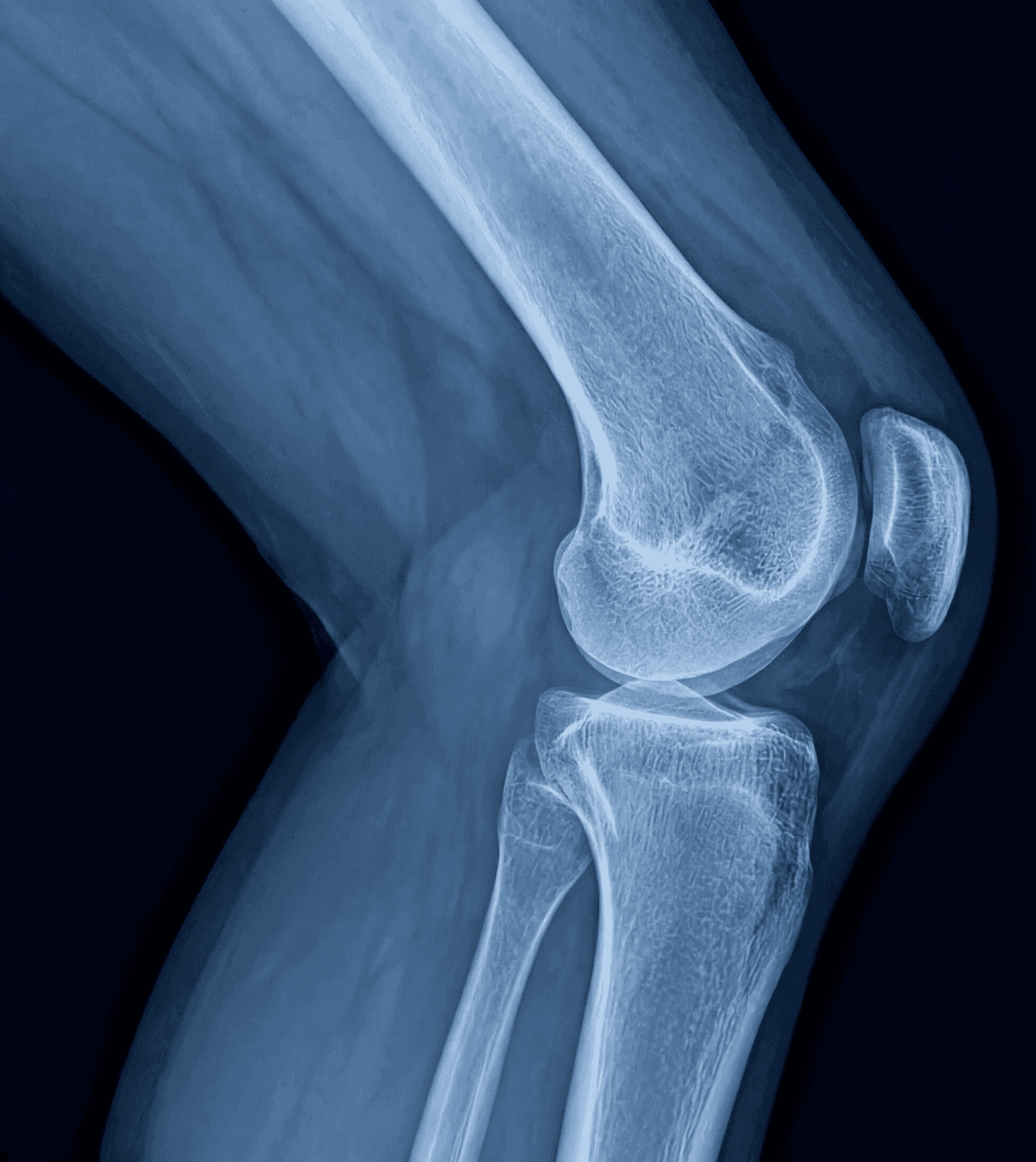 X-ray image of a human knee joint on a dark blue field, featuring caption text introducing "AgAIN Silver" sourced from reclaimed medical X-ray films.