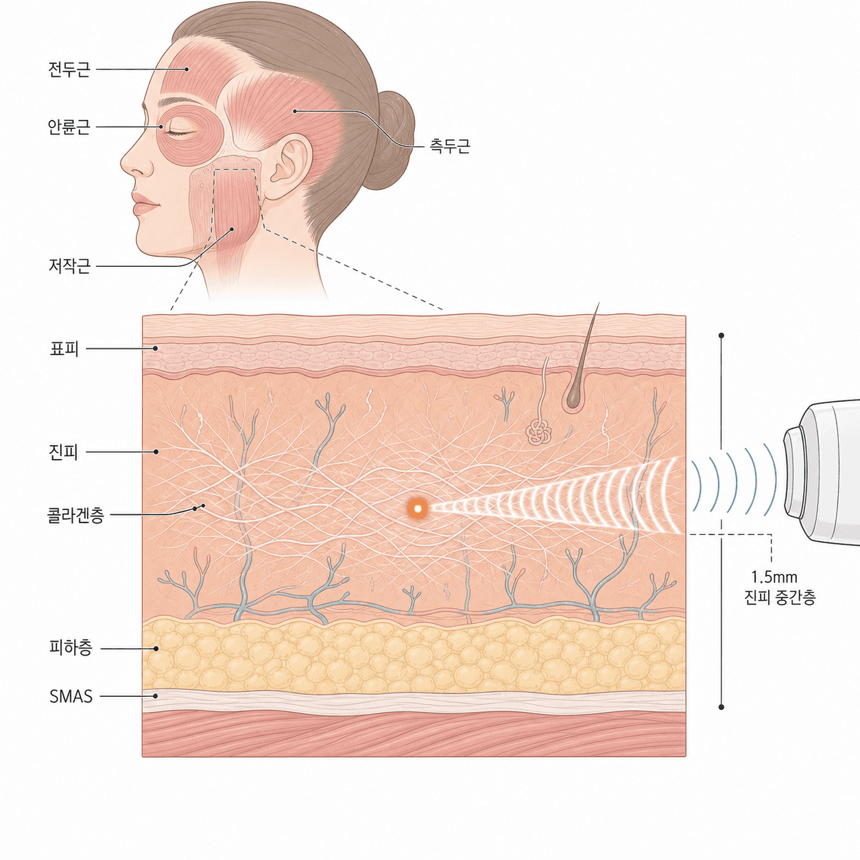 초음파 열점이 피부 속 정해진 깊이에 모이는 구조