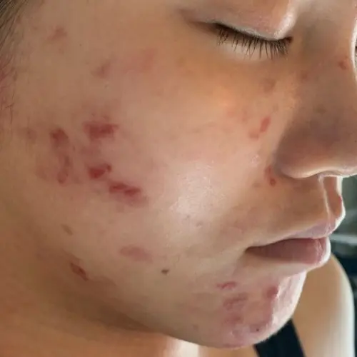 Before acne treatment at The Vancouver Aesthetician — skin picking acne breakouts with visible inflammation and scarring on compromised skin