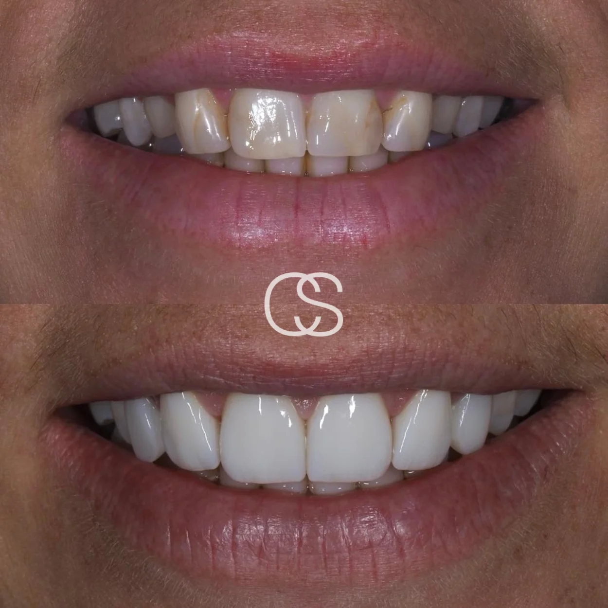 Before & After smile Veneers at Colac Smiles, Colac