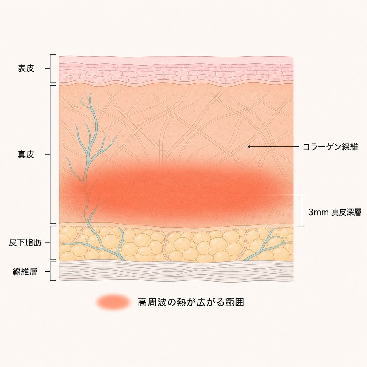 皮膚の断面図。表皮・真皮・皮下脂肪・線維層の位置と、高周波の熱が真皮の深い層に広がる様子を示している