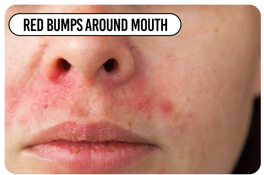 Red bumps around mouth