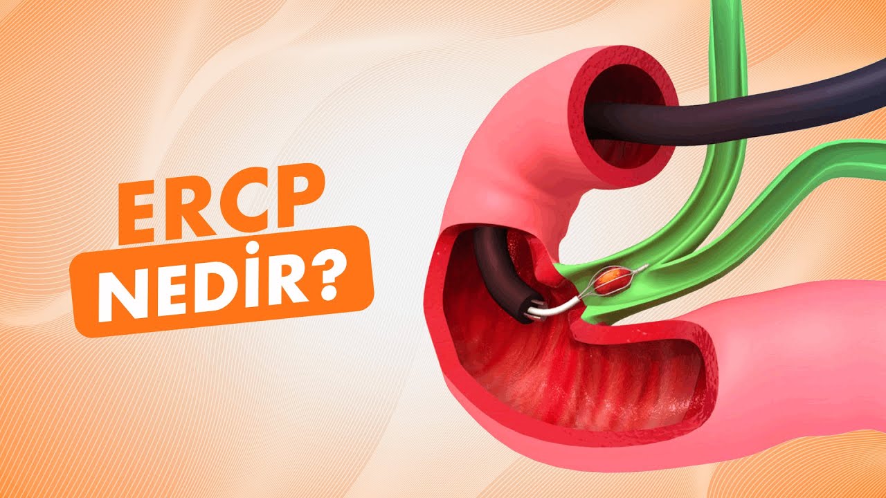 Safra ve Pankreas Kanalı Hastalıklarının Tanı ve Tedavisinde ERCP İşlemi
