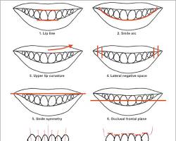 technical illustration focusing on "Gingival Zeniths" and "Incisal Edges." It contrasts a "Disharmonious Smile" (uneven gum heights, flat worn edges) with a "Harmonious Smile" (symmetrical gum scallops, youthful rounded edges), labeled with terms like "Smile Line" and "Buccal Corridor."