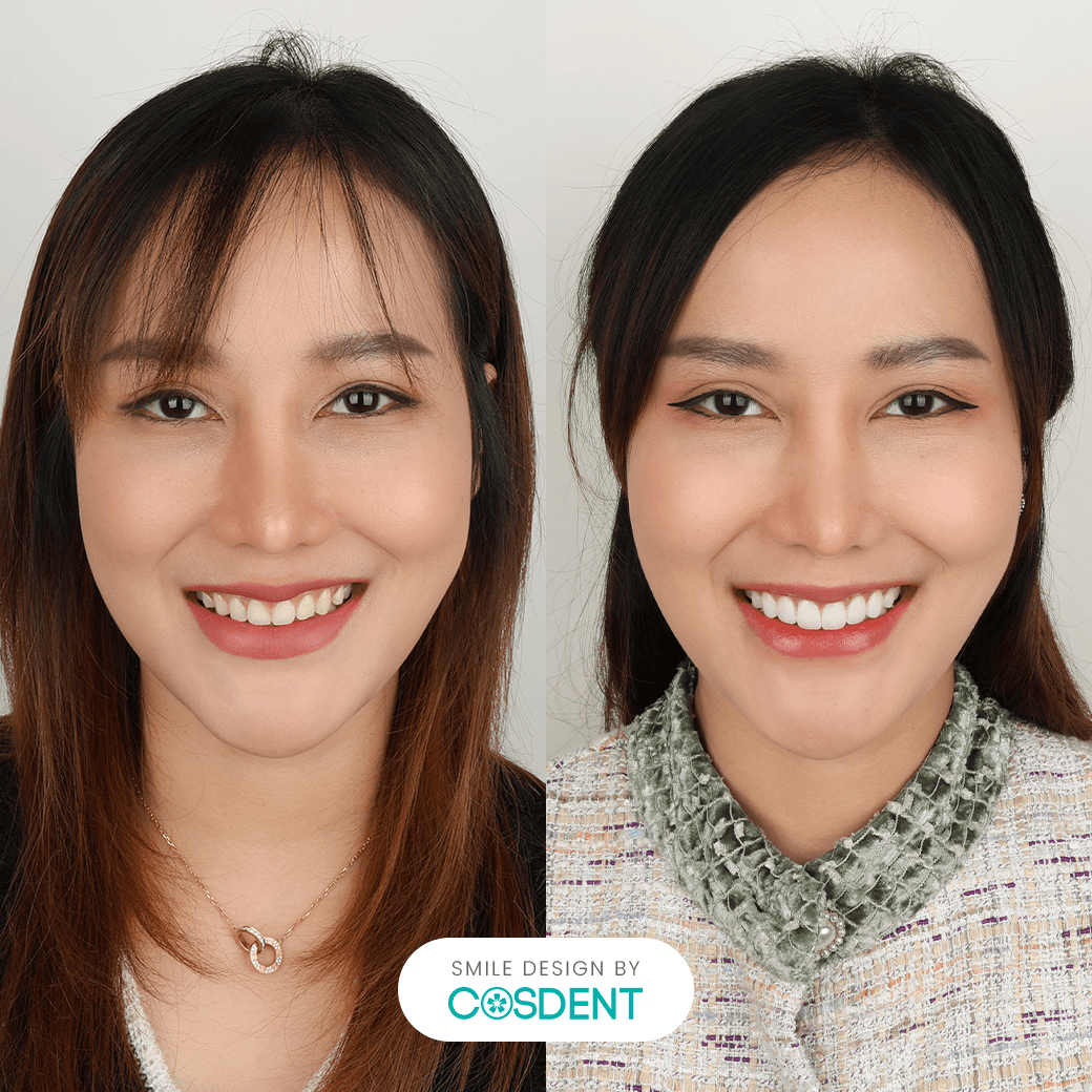 หน้ายาว ยิ้มกว้าง 16 ซี่