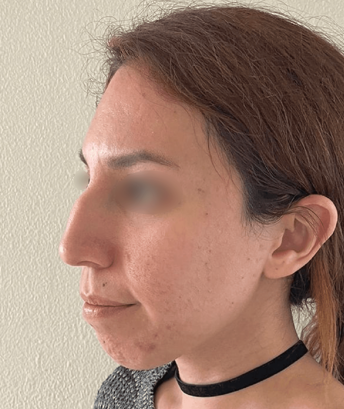 Rinoplastia resultado antes de la cirugía