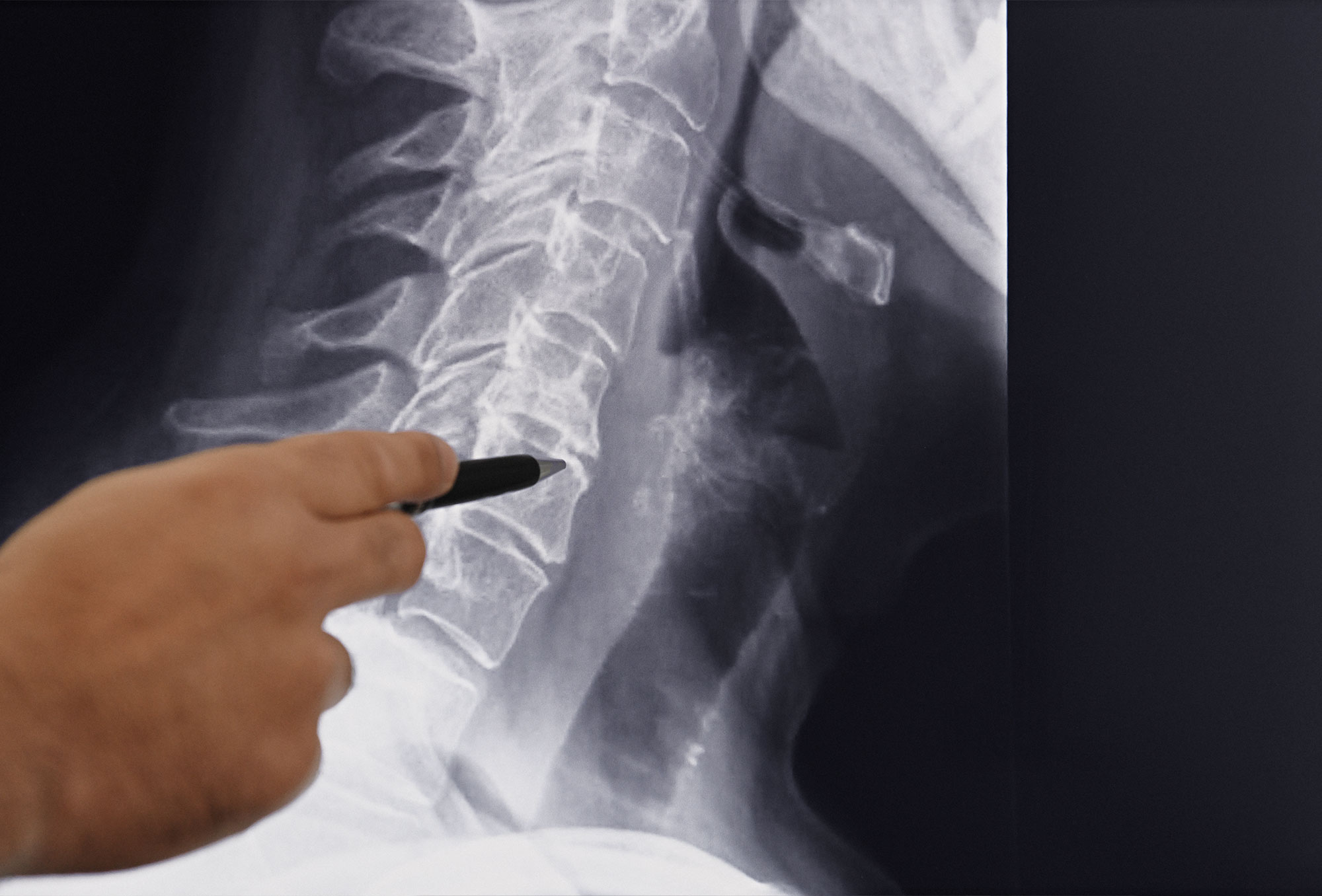 Abnützungserscheinungen / Arthrose