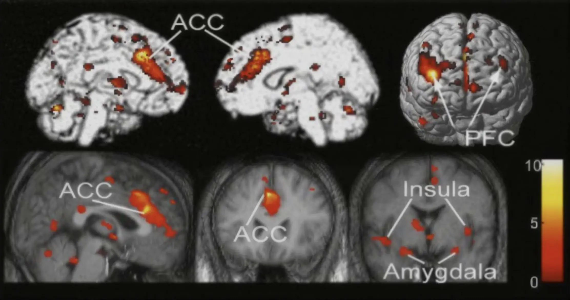 Brain activity (limbic system hyper responsiveness) whilst bruxing with a functional (left) and dysfunctional occlusion (right)