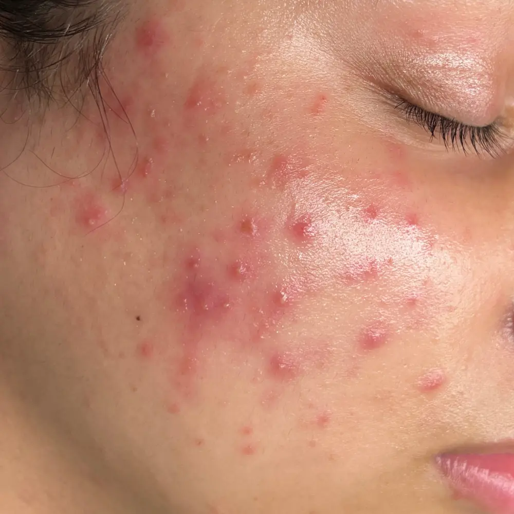 Before redness treatment at The Vancouver Aesthetician — severe inflammatory acne with significant redness and active breakouts on skin