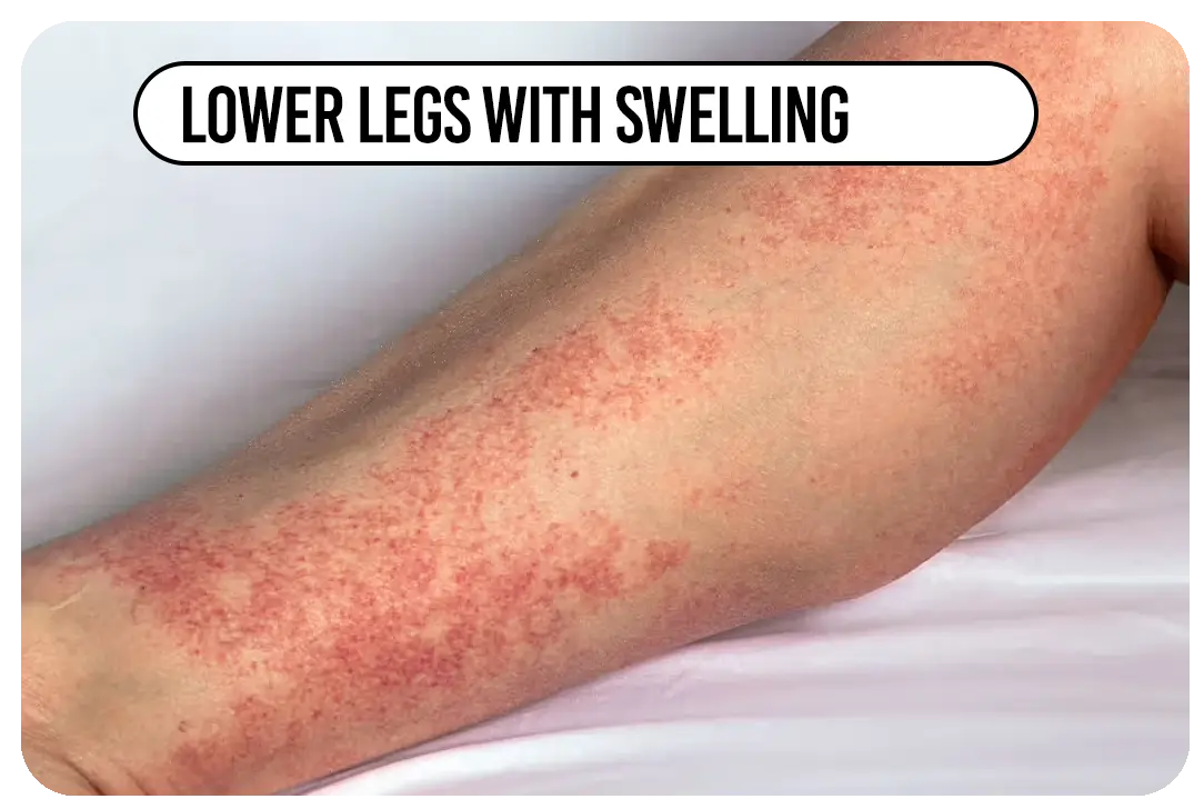 Lower legs with swelling