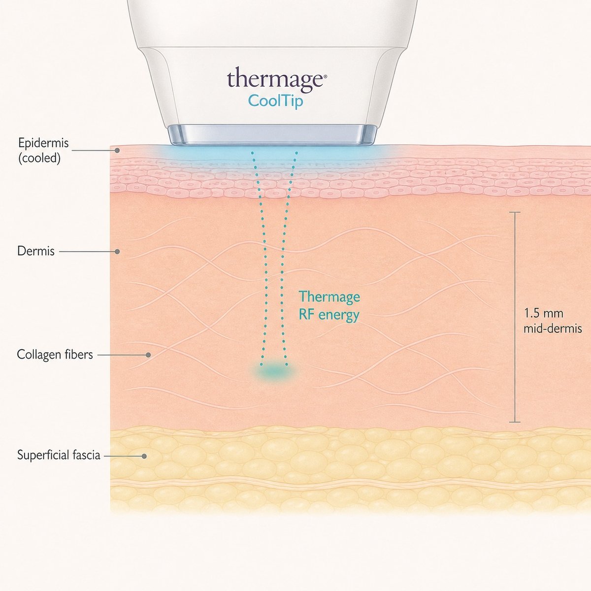 Diagram showing how Thermage RF energy reaches the dermis and superficial fascia of the neck while the epidermis is cooled