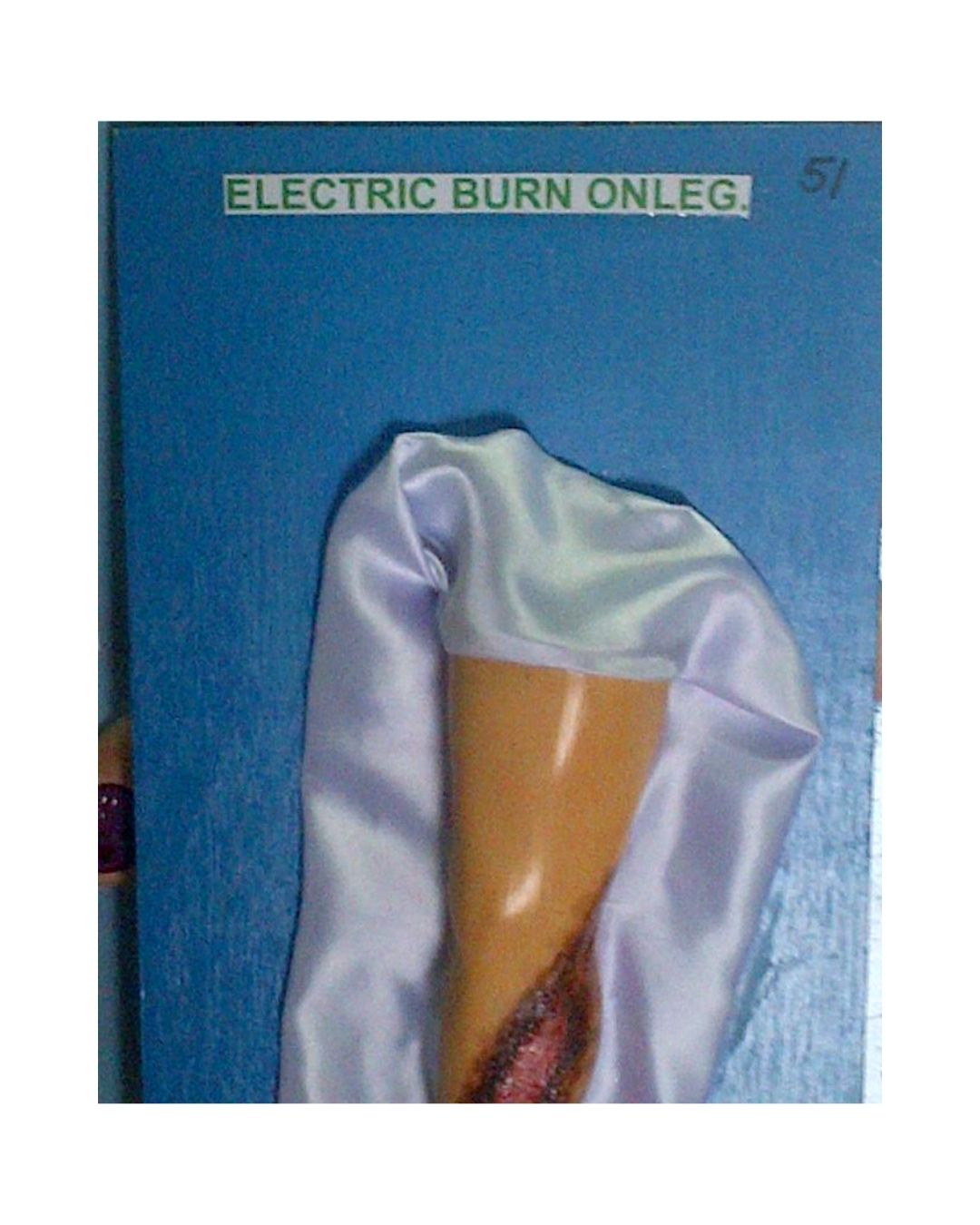 Electric Burn on Leg