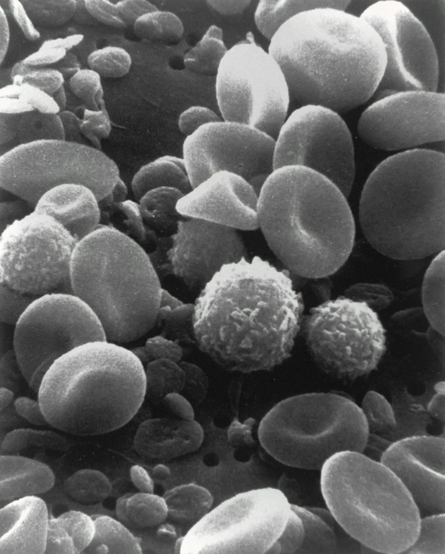 Effects of Leukocyte–Platelet-Rich Fibrin (L-PRF) in Different Intraoral Bone Grafting Procedures: A Systematic Review | Bloor-Yorkville Periodontics