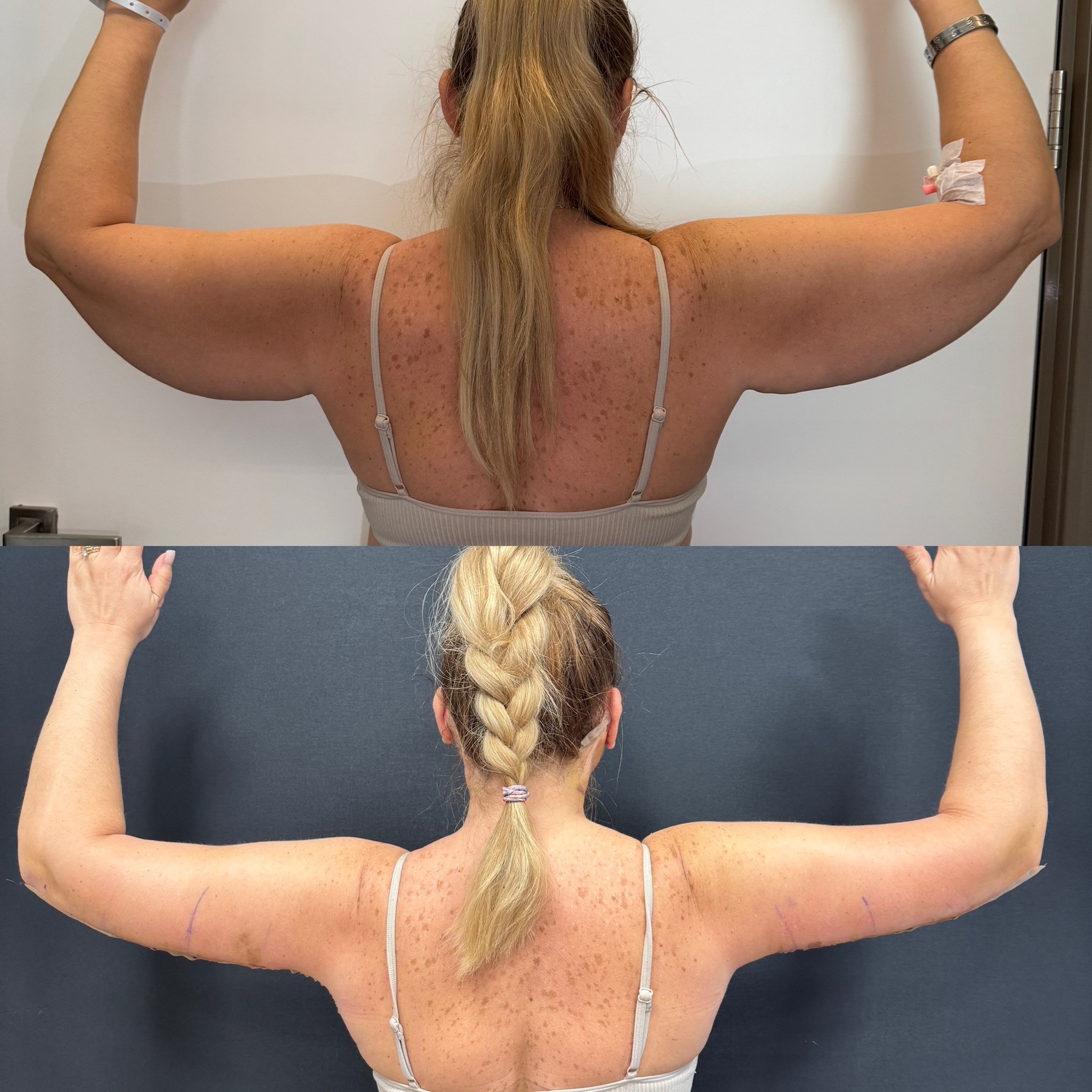 arm lift before after photo of Dr.CBS's patient in Istanbul, Turkey back view