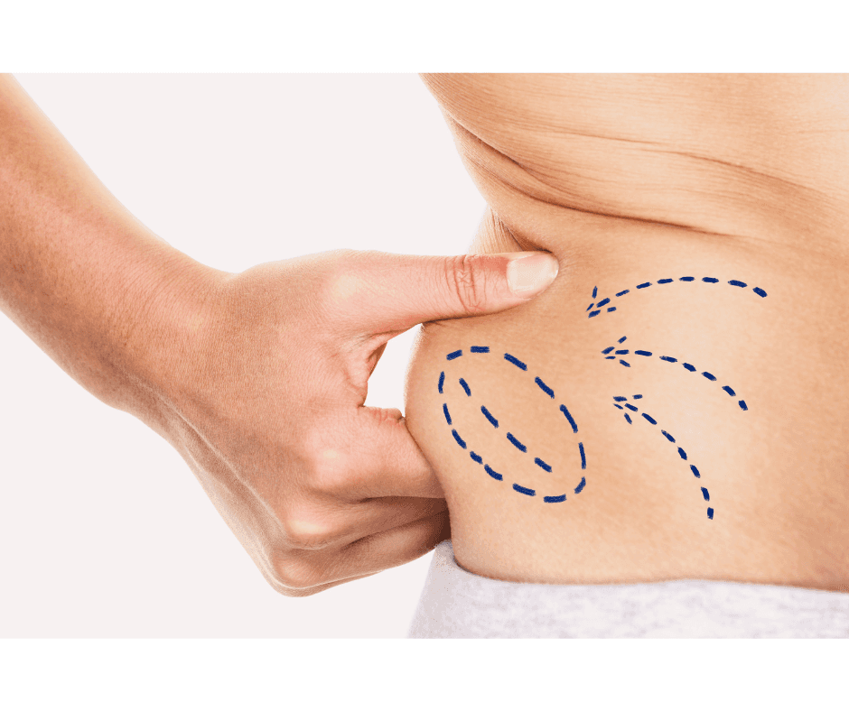 Liposuction vs Liposculpture: What’s the Real Difference?