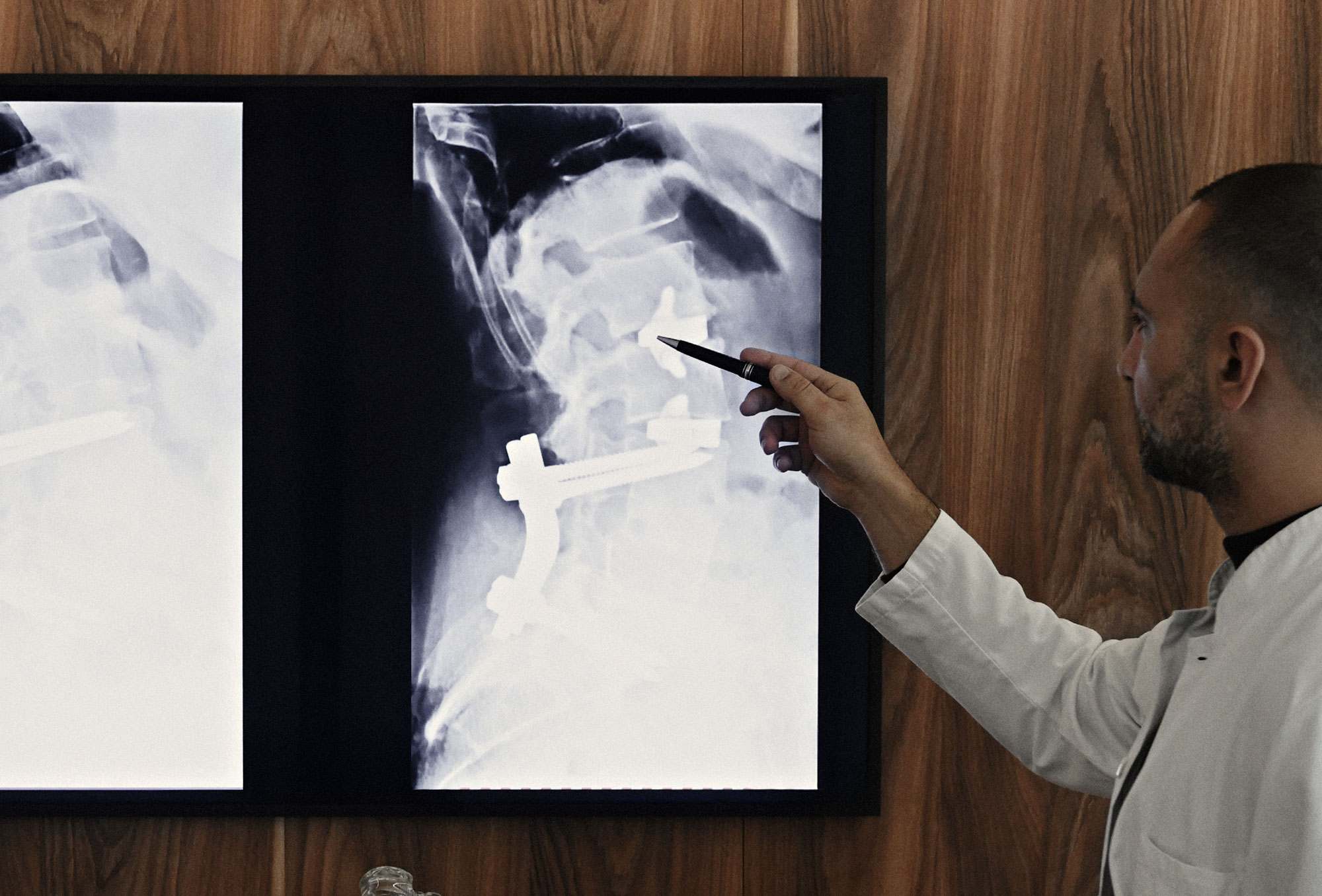 Revisionseingriffe der Wirbelsäul