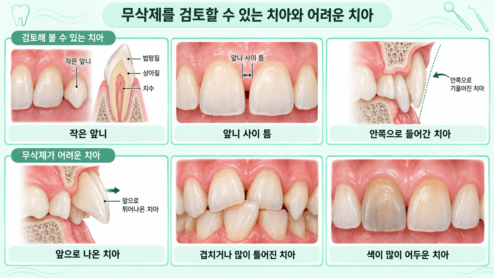 작은 앞니, 앞니 사이 틈, 안쪽으로 들어간 치아처럼 무삭제를 검토할 수 있는 치아와 앞으로 나온 치아, 틀어진 치아, 색이 어두운 치아처럼 어려운 치아를 나눈 일러스트